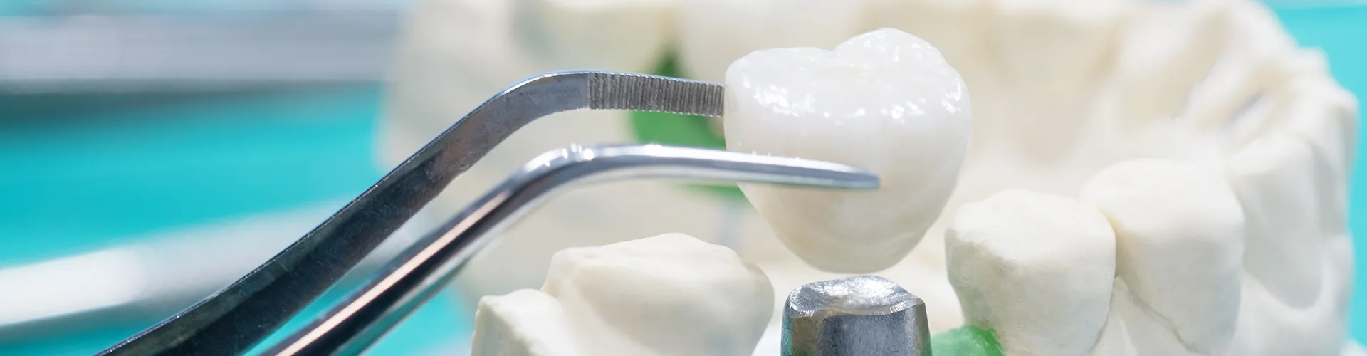 Close-up of a dental crown being positioned on an implant using dental tweezers, showcasing a restorative dentistry procedure.