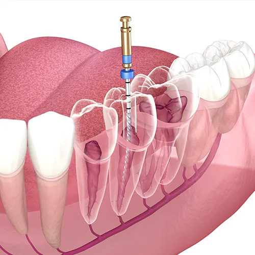 rendering of transparent teeth in jaw with a root canal tool inside