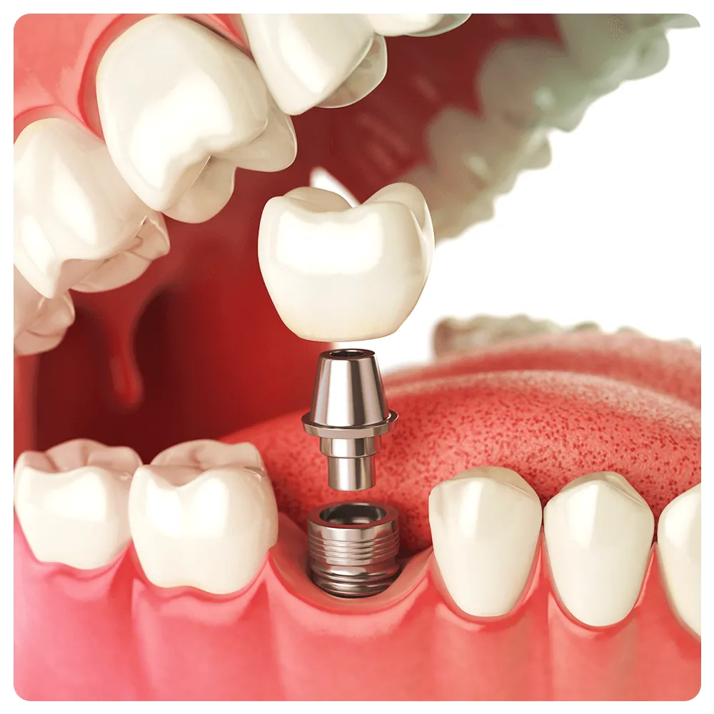 Dental implant illustration