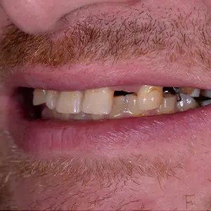 Before and after teeth