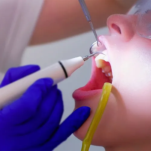 closeup of dental tools cleaning a patient's teeth