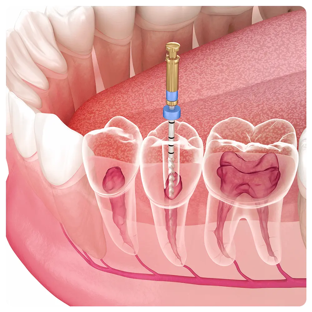 Illustration of root canal