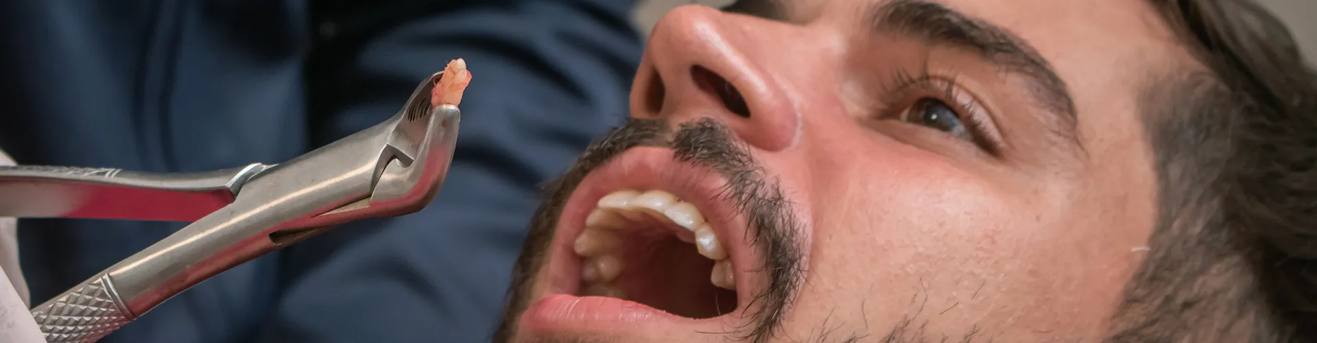 Close-up of a dentist holding an extracted tooth with dental forceps, highlighting a tooth extraction procedure.