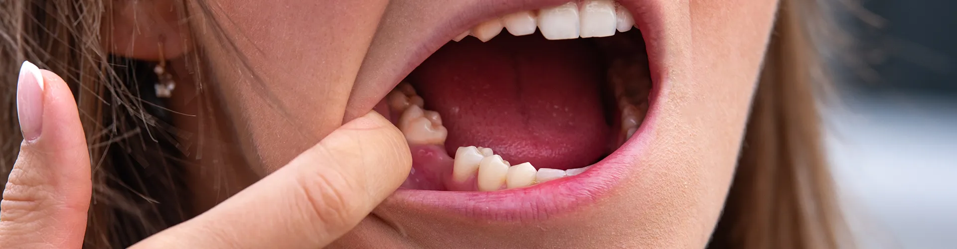 Close-up of a patient showing a missing tooth in the lower jaw, highlighting a gap in the dental arch and the potential need for restorative dental care.