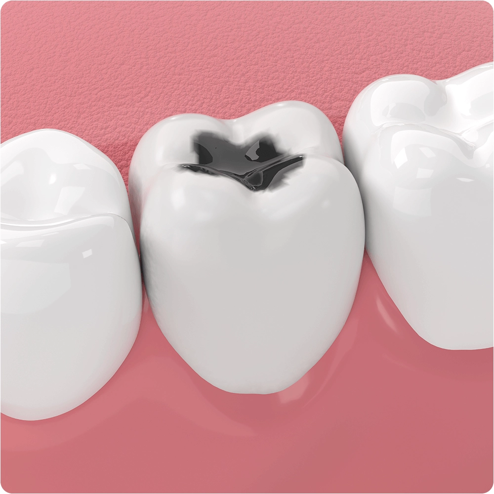 Illustration of tooth with cavity