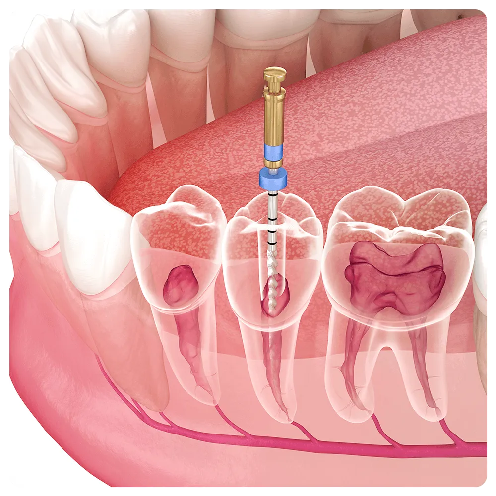 Illustration of root canal