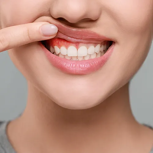 woman lifting lip to show inflamed gums