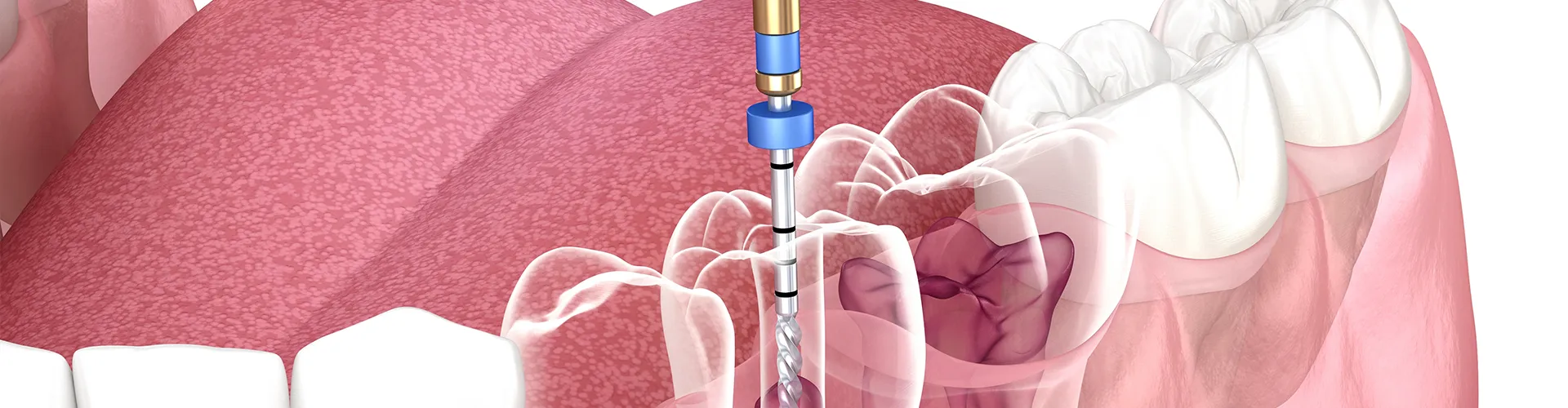 rendering of transparent teeth in jaw with a root canal tool inside