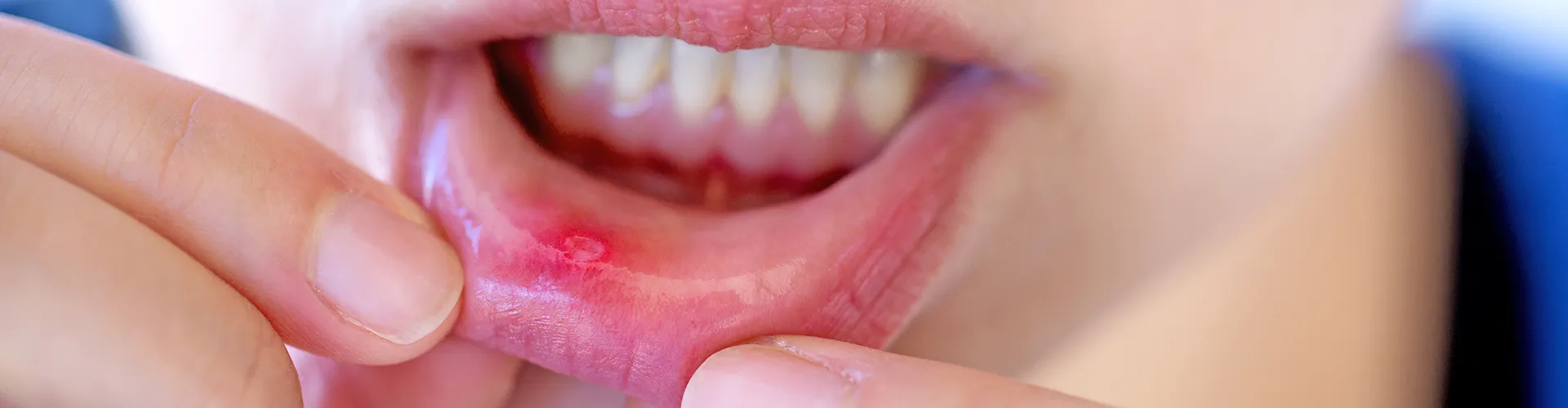 Close-up of a patient showing a mouth ulcer on the lower lip, emphasizing a common oral health issue.