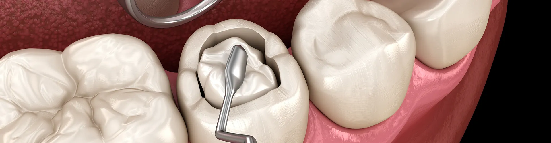 3D illustration of a dental filling procedure showing a composite material being placed in a molar cavity.