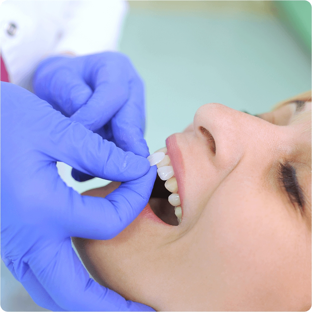 Dentist putting veneers